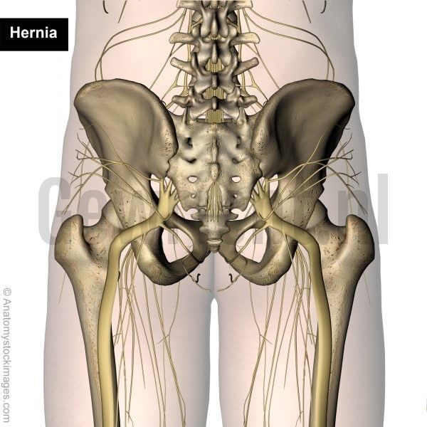 Lubar_radicular_syndrome_back