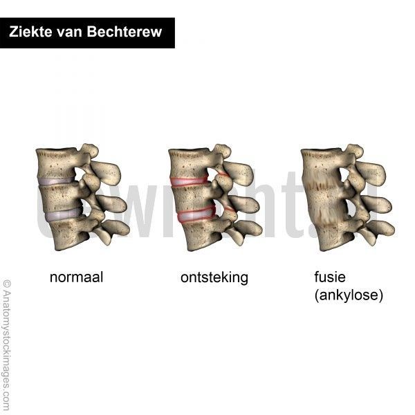 SA-vertebrae