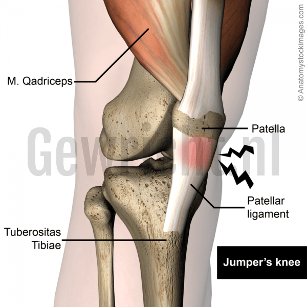 knee-jumpers-knee-jumper-pain-patellar-ligament-tendinitis-patella-quadriceps-tendon-tuberositas-tibiae-front-skin-names