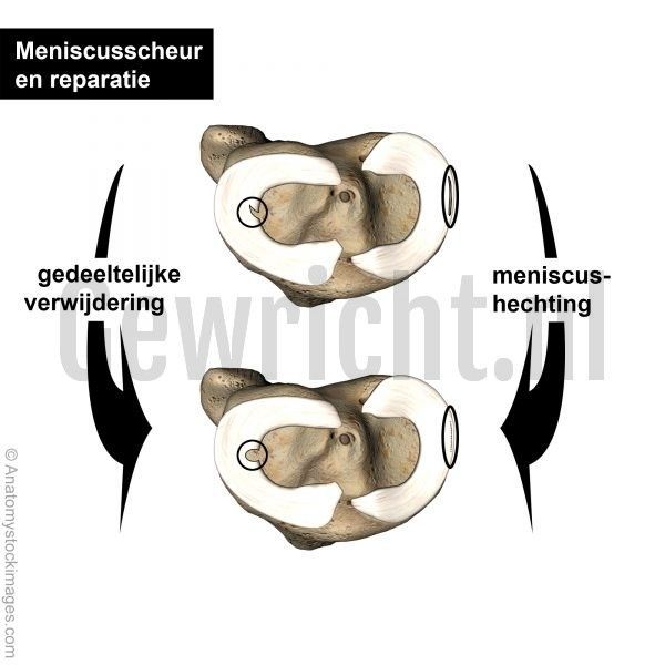 meniscus-tear-treatment