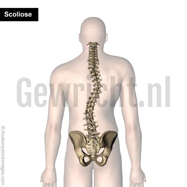 scoliose
